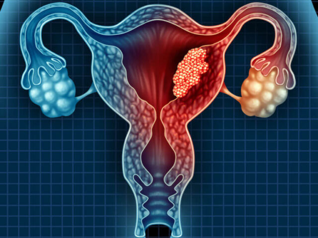 Unveiling the Hidden Dangers: What You Need to Know About Rare Gynae Cancers